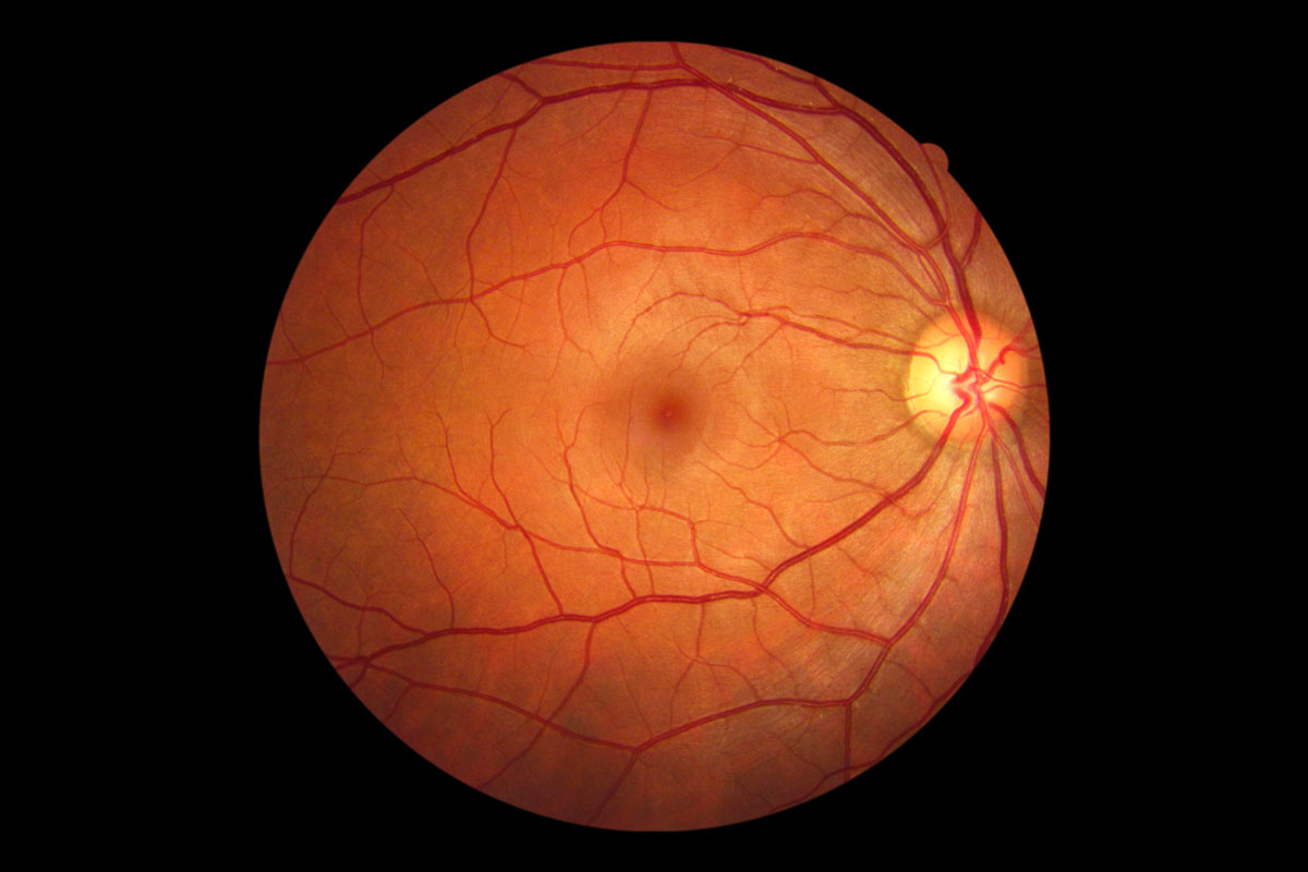 Retinal Imaging